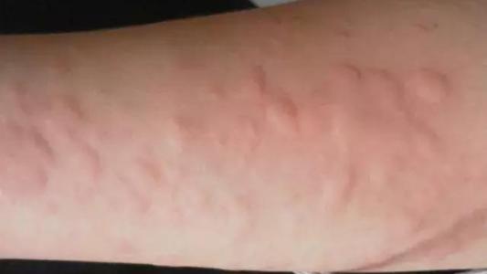 Ƥ���� �Ӿ��������ʲôԭ��