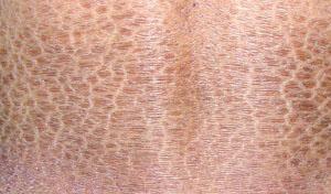 鱼鳞病的危害福州皮肤医院