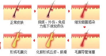 毛囊炎皮肤病的护理措施有哪些