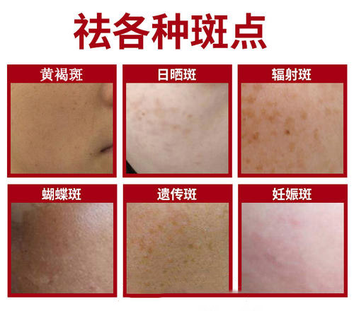 ��߸���Ƥ��ҽԺ�ĸ���-���ְߵ�֢״ͼ