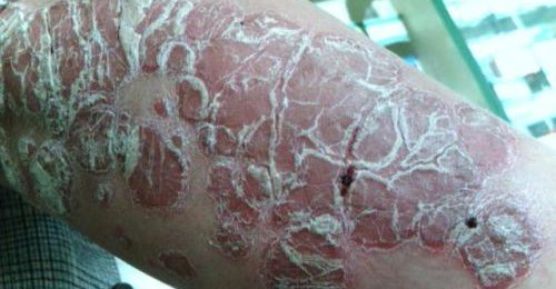 �����ݻ���Ƥ��ר��ҽԺ��ţƤѢ������֢״�ص�